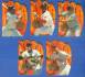 1994 Flair 'HOT GLOVE'  - Lot of (5) Different w/KIRBY PUCKETT